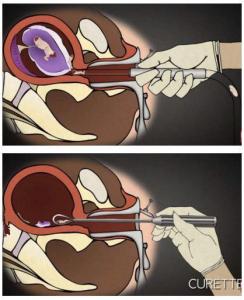 切勿轻视人工流产对女性的伤害,人工流产对女性造成的伤害有哪些