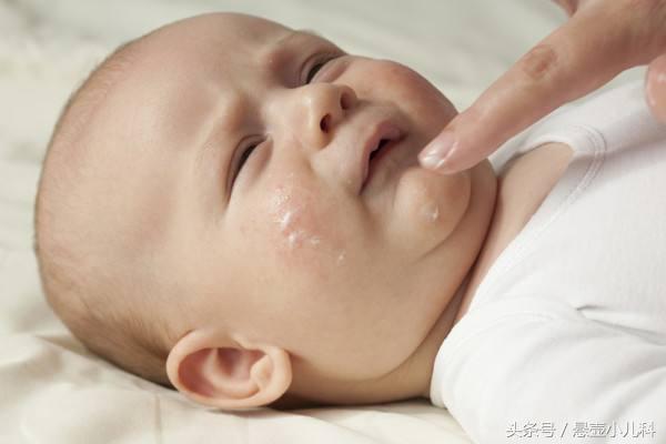 去看湿疹医生开了一大堆药,在医院给孩子看湿疹的经历