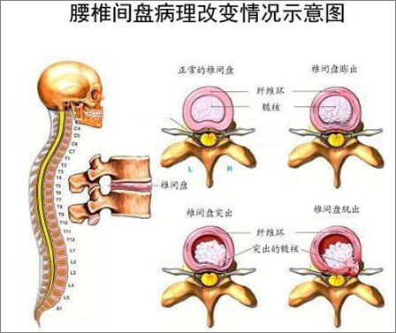腰椎间盘突出4个等级,你到第几级了?