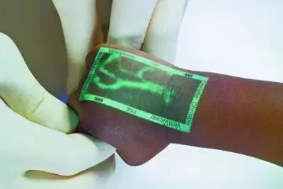 这个黑科技能照亮你的血管，让护士好好地给你扎针！