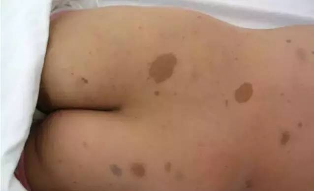 初生婴儿痣和胎记怎么区别,孩子长痣和胎记区别