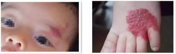 初生婴儿痣和胎记怎么区别,孩子长痣和胎记区别