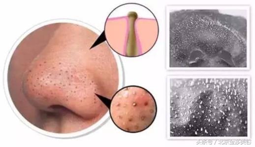 怎么挤黑头的正确方法,手挤黑头跟工具挤黑头有什么区别