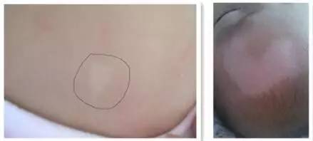 初生婴儿痣和胎记怎么区别,孩子长痣和胎记区别