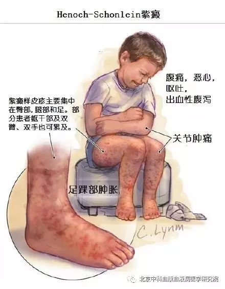 过敏性紫癜如何从根源根治,过敏性紫癜为什么不容易根治