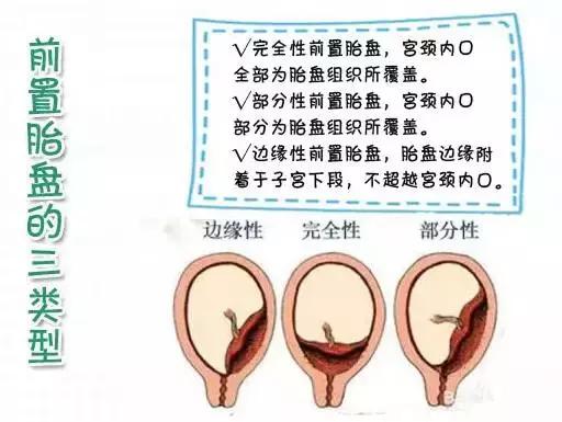 孕期胎盘前置需要保胎吗,前置胎盘的孕妇最佳的处理方法