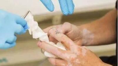 治疗白癜风的常识都包括哪些,白癜风怎么反向治疗