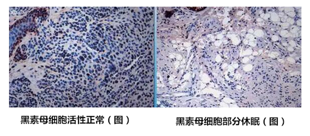 治疗白癜风的常识都包括哪些,白癜风怎么反向治疗