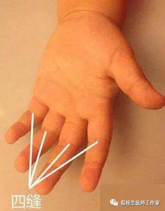 小宝宝脾胃虚弱积食便秘怎么调理,孩子积食脾胃差医生一招就搞定