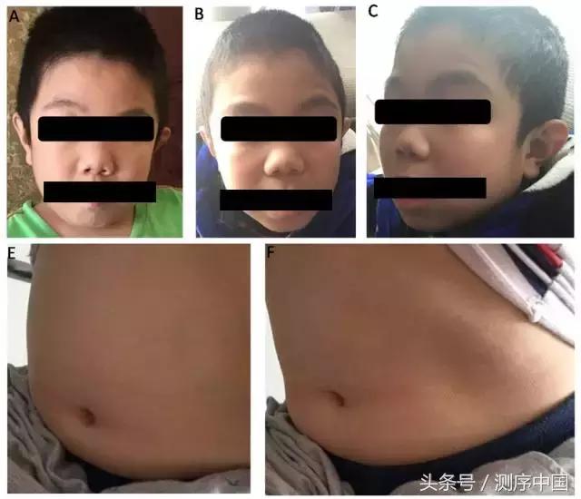 余永国儿科学博士,余永国教授