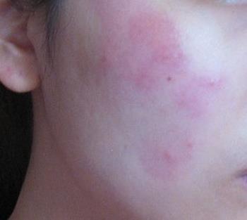 白醋洗脸可以有效去除脸上痘,白醋洗脸可以去除青春痘吗