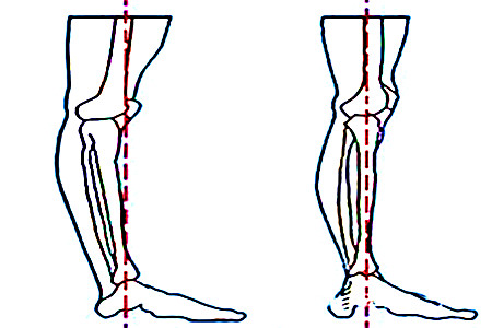 脑瘫的九种异常姿势改善,脑瘫患者膝反张怎么康复