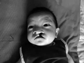 2岁儿童牙齿反颌矫正方法图片,12岁前必须矫正牙颌畸形吗