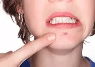 男人下巴频繁长痘的原因吃什么药,下巴长痘怎么治疗才能根治