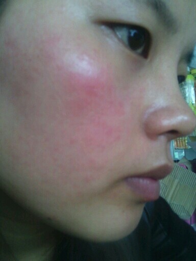 皮肤晒伤发红最快修复方法,皮肤晒黑了怎么变白