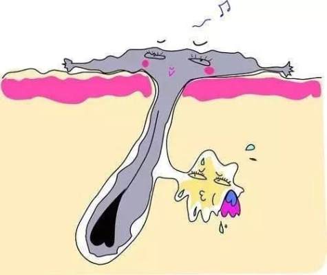 痘痘反反复复还可以护肤吗,痘痘长期下不去