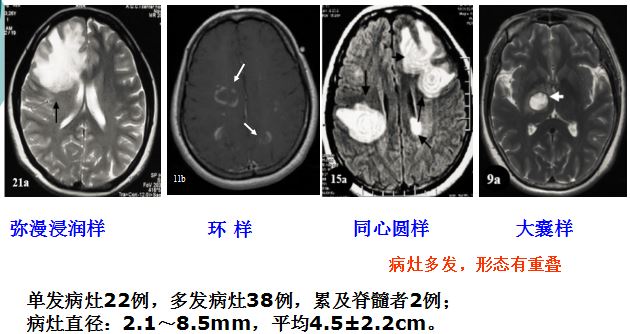医学干货：瘤样炎性脱髓鞘病与胶质瘤、PCNSL临床、影像鉴别