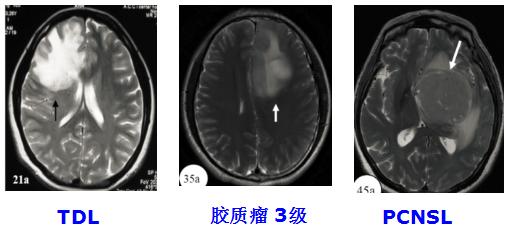 医学干货：瘤样炎性脱髓鞘病与胶质瘤、PCNSL临床、影像鉴别