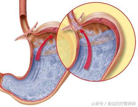 感觉胃酸多吃什么可以缓解,感觉自己胃酸多怎么办
