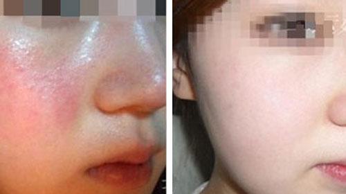 激素脸干燥脱皮发痒,激素脸脱皮怎样补水