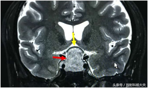 男子性腺功能减退治疗,男子脑内有多个肿瘤