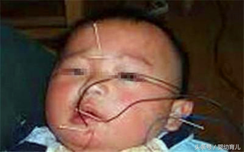 这种电器家里随处可见，却还是有家长忽视致13个月宝宝口眼歪斜