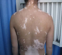 白斑怎么治疗才能治疗好呢,老年点状白斑有啥办法治疗