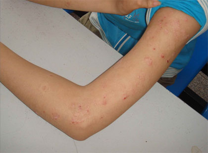 3种泡澡方法可以治疗牛皮癣,熏蒸和泡澡哪个治疗牛皮癣好