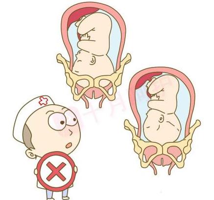 孕妈请注意最容易引起胎儿畸形,孕妈臀位