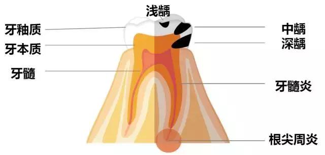 龋齿属于虫牙吗,蛀牙龋齿虫牙是怎么形成的