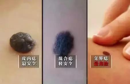 长在什么地方的痣易癌变,每一个痣都是代表疾病吗