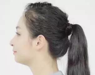 年轻人如何改善发量稀疏,发量稀少怎么补救最快最有效