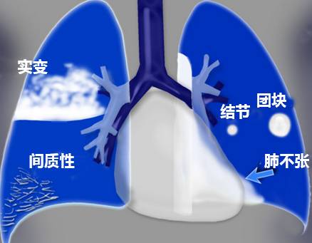 正常胸片如何阅读,胸片阅读的方法和技巧