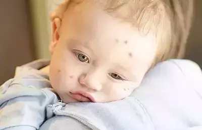 宝宝驱蚊止痒爆款榜单,驱蚊止痒婴儿测评