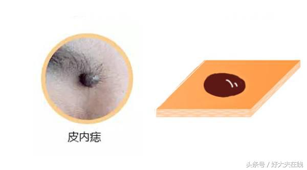 痣破损多久会有癌变的可能,浅表脂肪瘤样痣会癌变吗