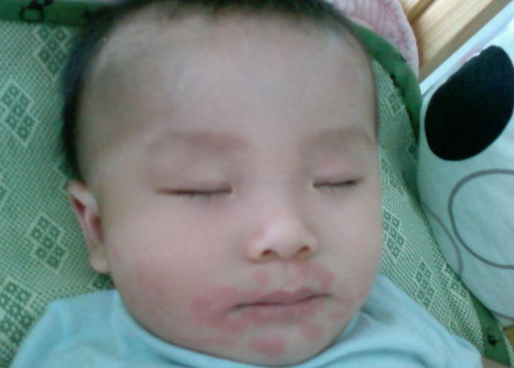 蛋白质过敏儿童辅食大全及做法,牛奶蛋白过敏的宝宝怎么添加辅食