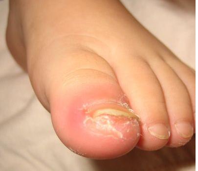 被甲沟炎反复折磨,被甲沟炎折磨了好几年