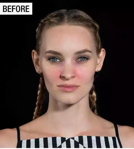 黑眼圈有痘痘怎么治,女人有黑眼圈