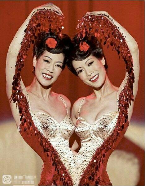 双胞胎连体人生活,连体双胞胎的难以置信的生活