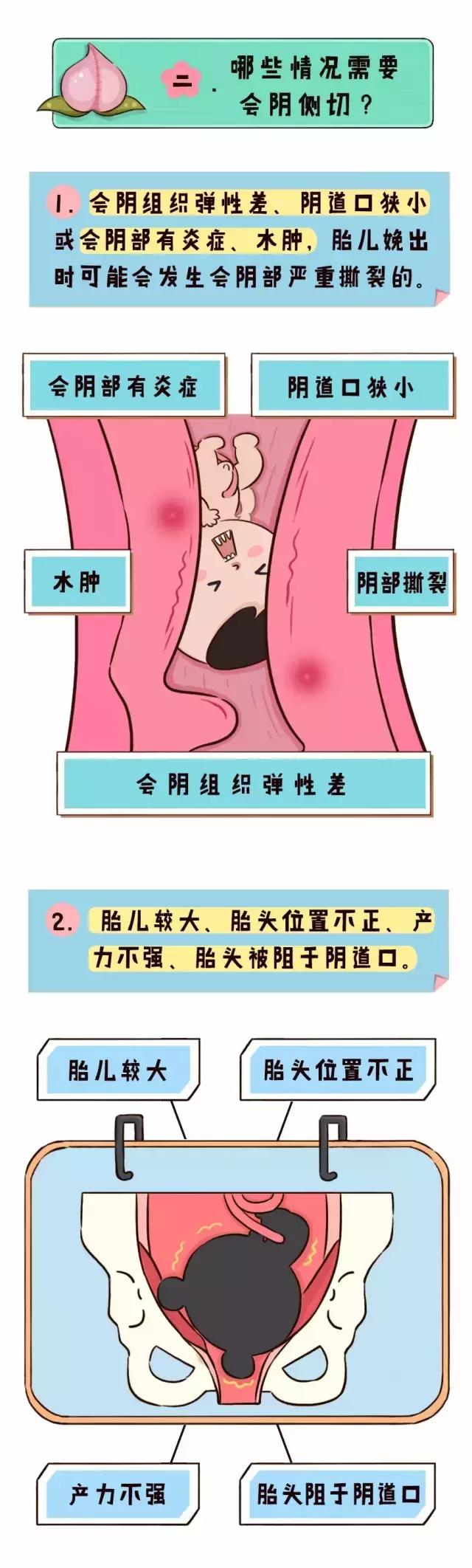 哪种情况需要侧切,侧切到底该不该做