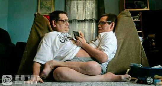 双胞胎连体人生活,连体双胞胎的难以置信的生活