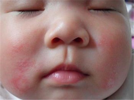 宝宝起湿疹能不能总用药,宝宝出湿疹用什么药膏好