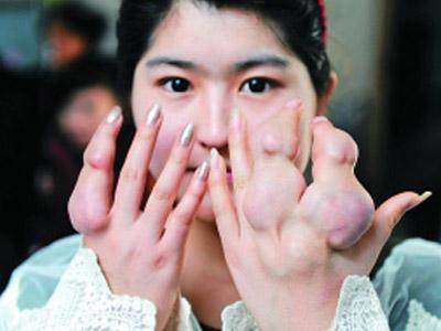 风湿性关节炎喝酒的严重后果,关节炎和风湿性关节炎的区别