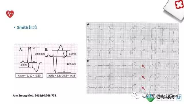 「心声」从机制到临床，一起认识左束支阻滞！