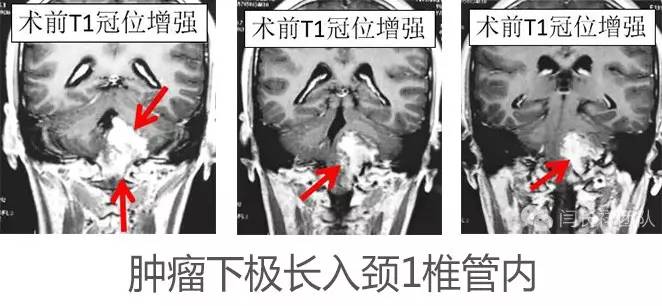 喝水容易呛是怎么回事是肺癌,老人喝水容易呛咳怎么办