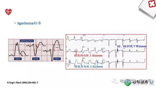 「心声」从机制到临床，一起认识左束支阻滞！