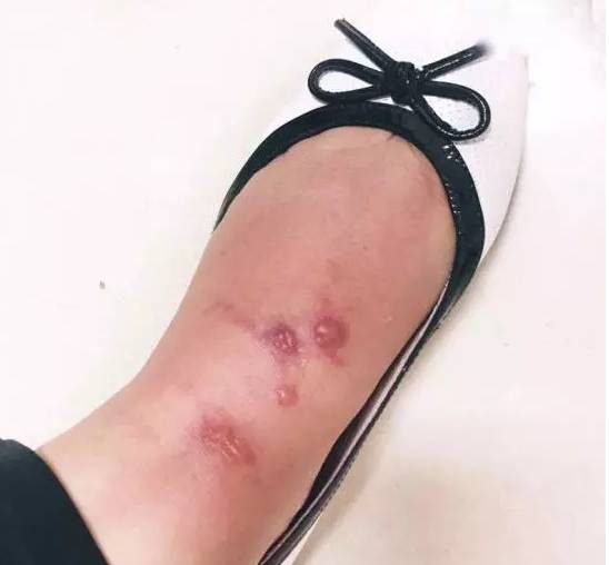 被宝宝咬后皮肤发黄是什么原因,婴儿被虫子咬过之后的皮炎