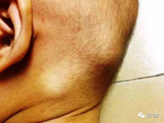 七个月宝宝皮下有个疙瘩,新生儿皮下小疙瘩会跑