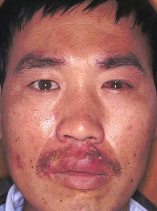 白塞氏病最佳治愈方法有哪些,白塞氏病最佳治疗方法