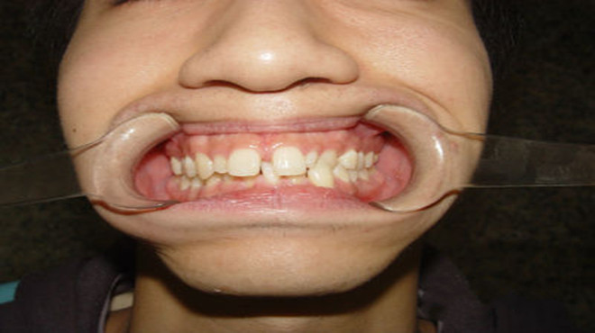 牙齿缝隙越来越大能矫正吗,洗牙会让牙齿缝隙越来越大吗